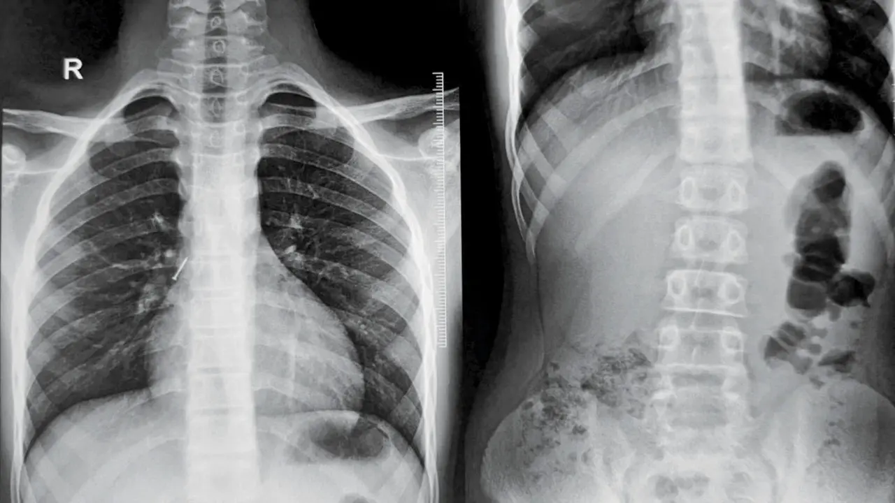 ​Mumbai doctors remove pushpin stuck near boy’s lungs in delicate surgery 