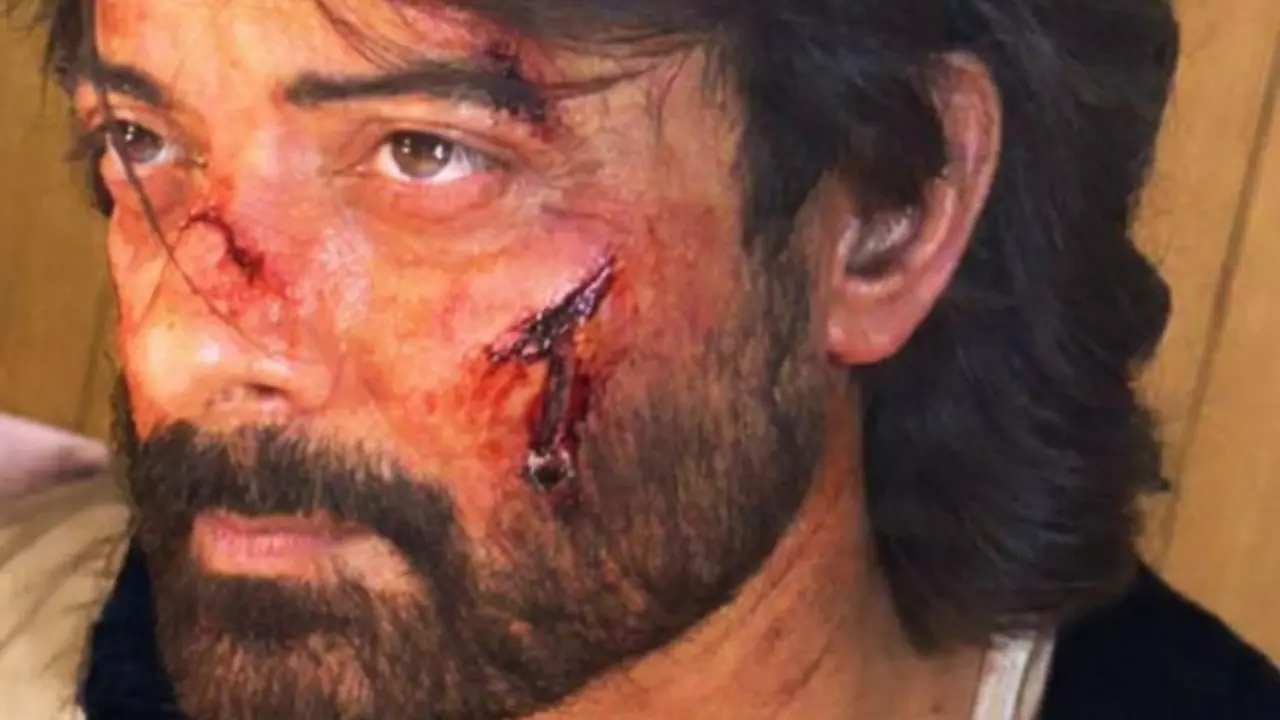 A bloody and bruised Rahul Bhat shoots for his next Netflix project 